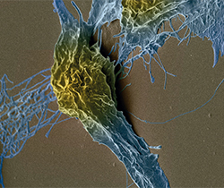 Imagen de una célula deteriorada por cáncer