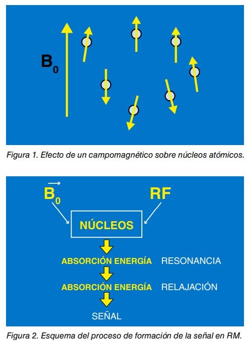 Esquemas del efecto de un campo magnético sobre núcleos atómicos y de la formación de la señal en resonancia magnética.